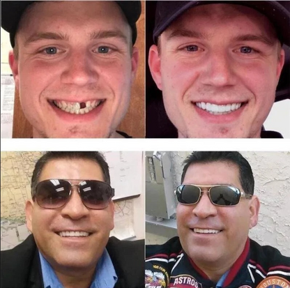 Adjustable Snap-On Dentures for Comfortable Fit